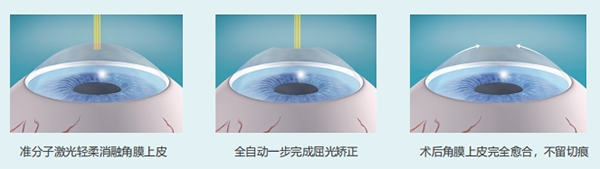 嘉兴爱尔眼科医院-睛逸Smart全激光